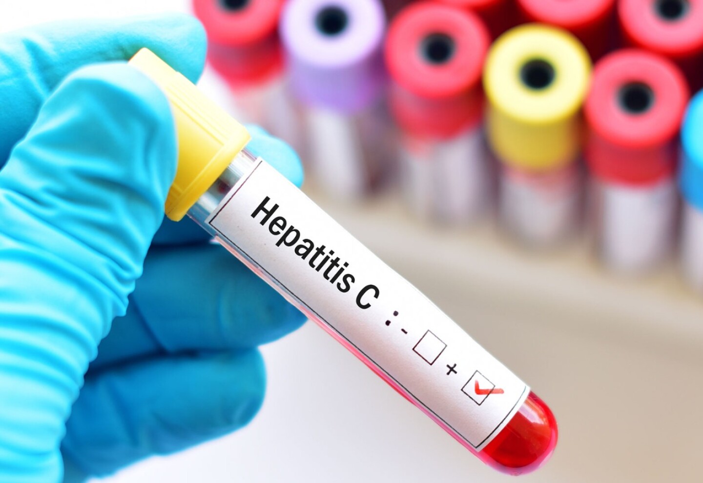hepatitisC